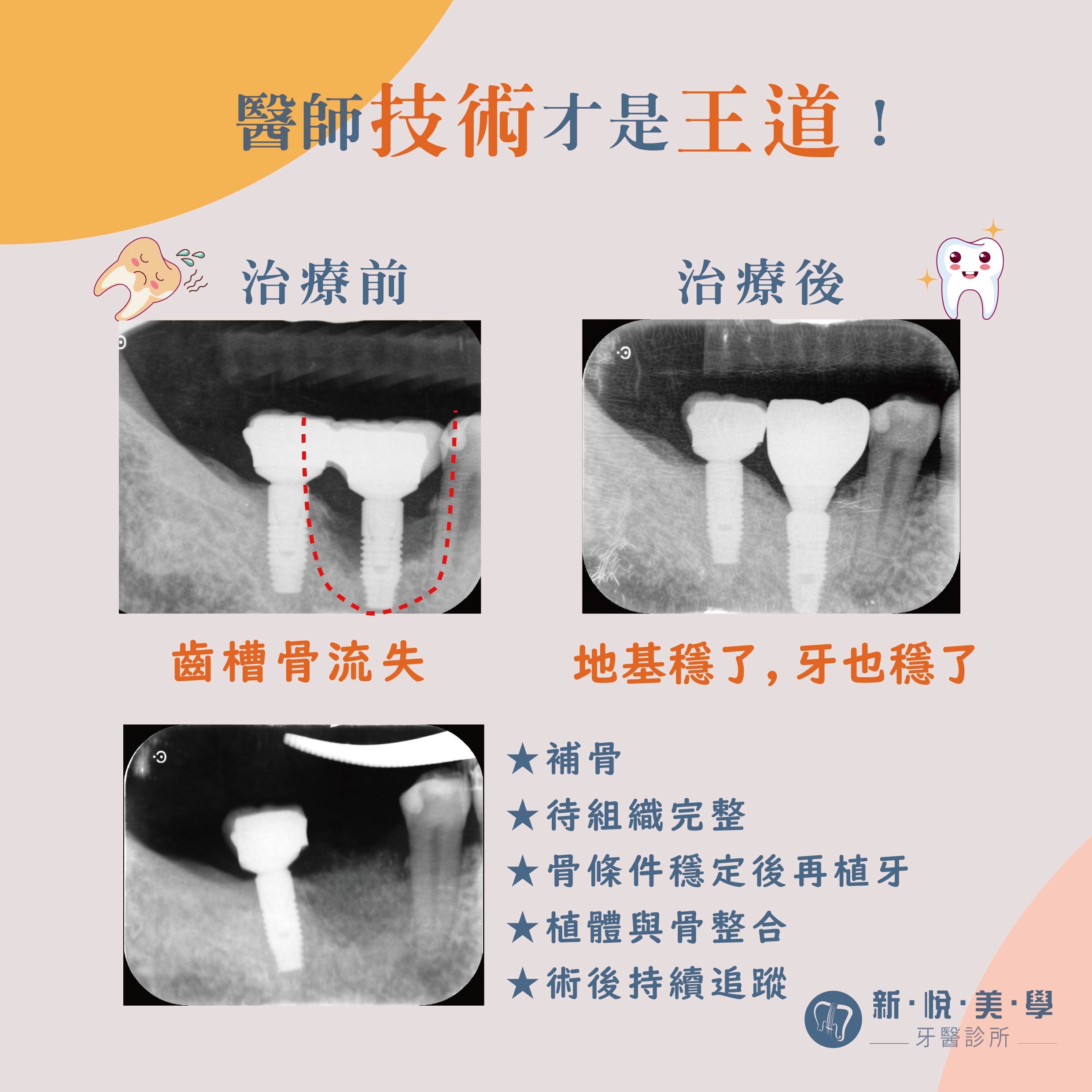 別人的植牙壞掉。骨頭被吃掉。看我如何重建的第2張圖片